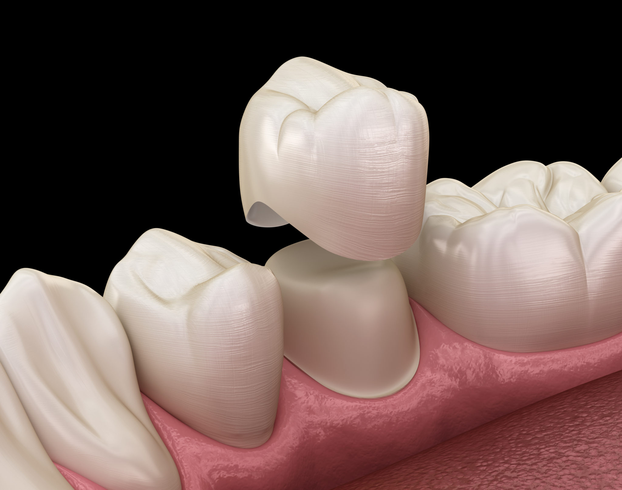 Porcelain Crowns And Bridges Fred Dahm Dentistry